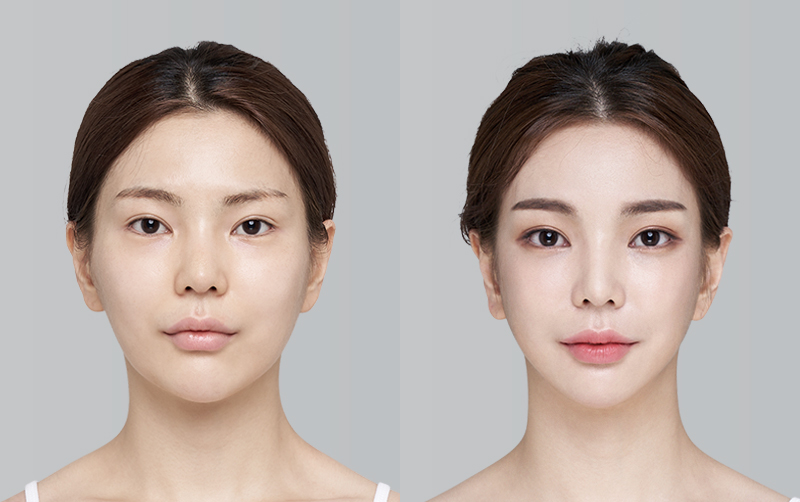전후사진