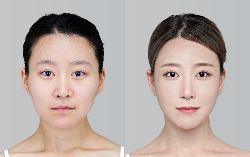 전후사진