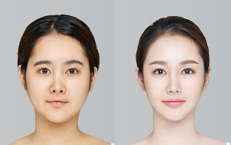전후사진