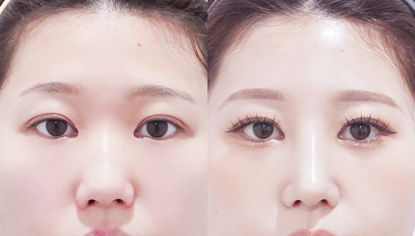 전후사진