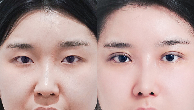 전후사진