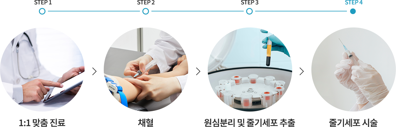 줄기세포 시술방법